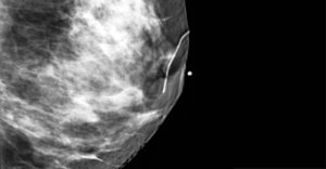 A Guide to Radiology & Oncology Skin Markers: Mammography X-ray